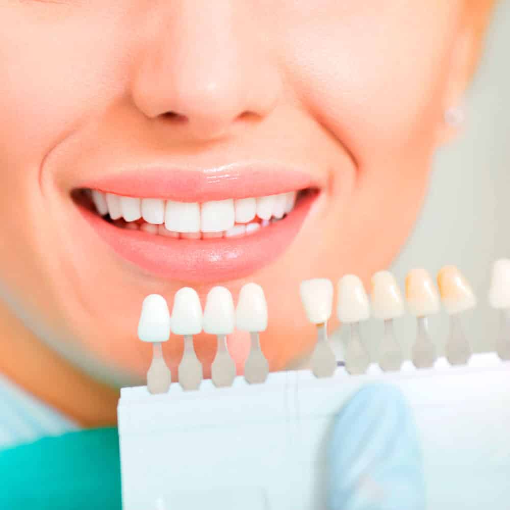 Carillas Dentales Clinicas Optima Dental