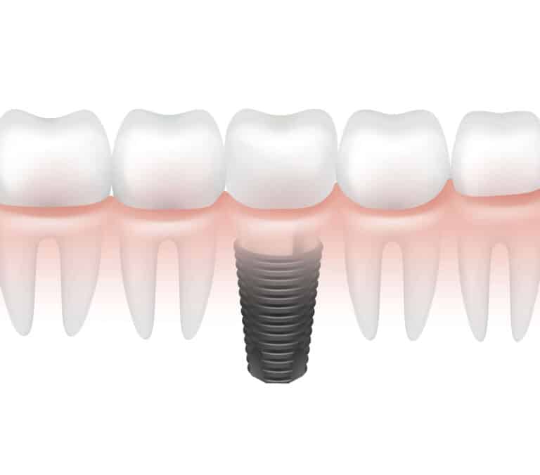 all on four implantes dentales Madrid